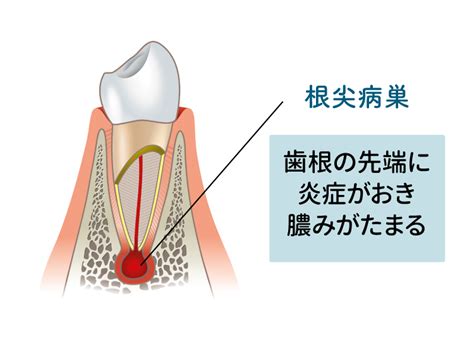 病巢 意味|病巣／病竈（びょうそう）とは？ 意味・読み方・使い方をわか。